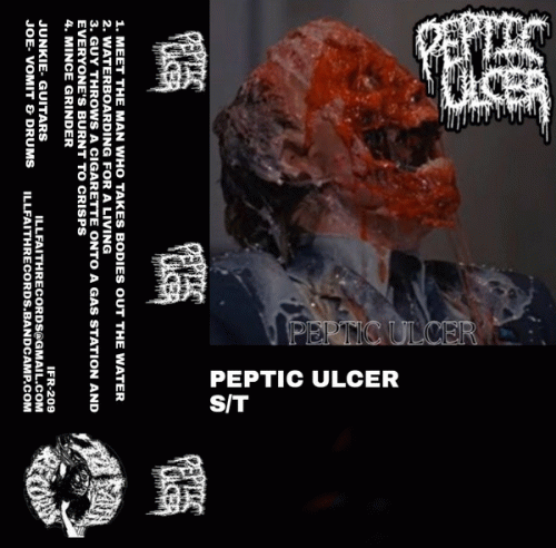 Peptic Ulcer : Peptic Ulcer